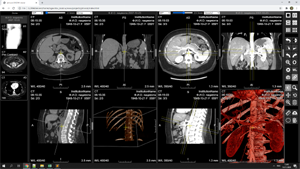Viewing abdominal vessels CT study: synchronizing 2 series in MPR+3D mode.